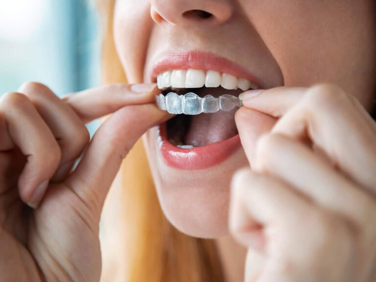 A white woman puts an Invisalign retainer over her top teeth.