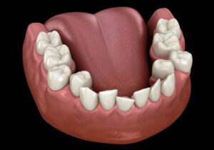tooth-crowding-correction