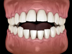 Open-Bite-Correction of boggs dentistry