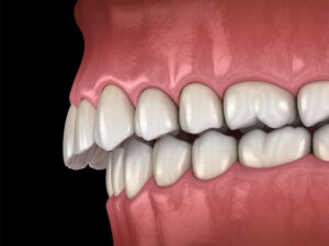 Overbite-correction-treatment photo 1