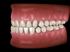 Bite Corrections underbite photo
