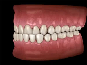 Bite Corrections underbite photo